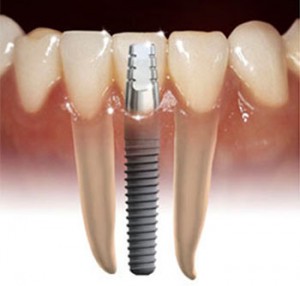 implant Dental Implant Photo